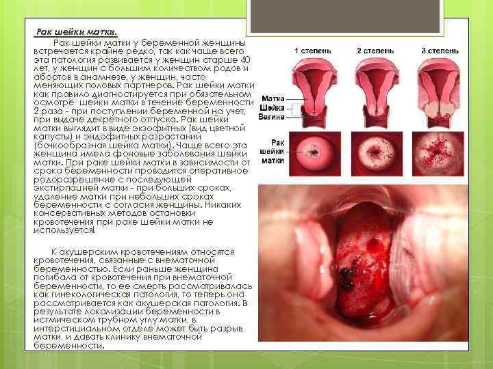 Рак шейки матки у беременной женщины встречается крайне редко, так как чаще всего эта