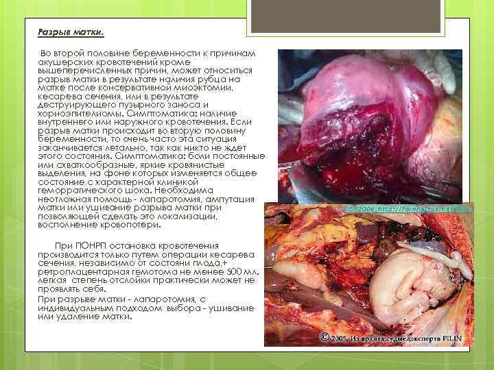 Разрыв матки. Во второй половине беременности к причинам акушерских кровотечений кроме вышеперечисленных причин, может