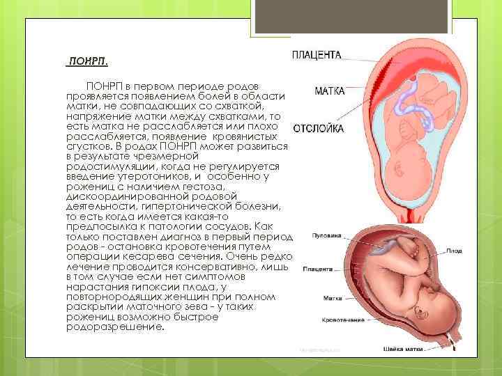 ПОНРП в первом периоде родов проявляется появлением болей в области матки, не совпадающих со