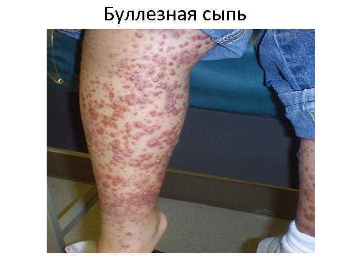 Буллезная сыпь 