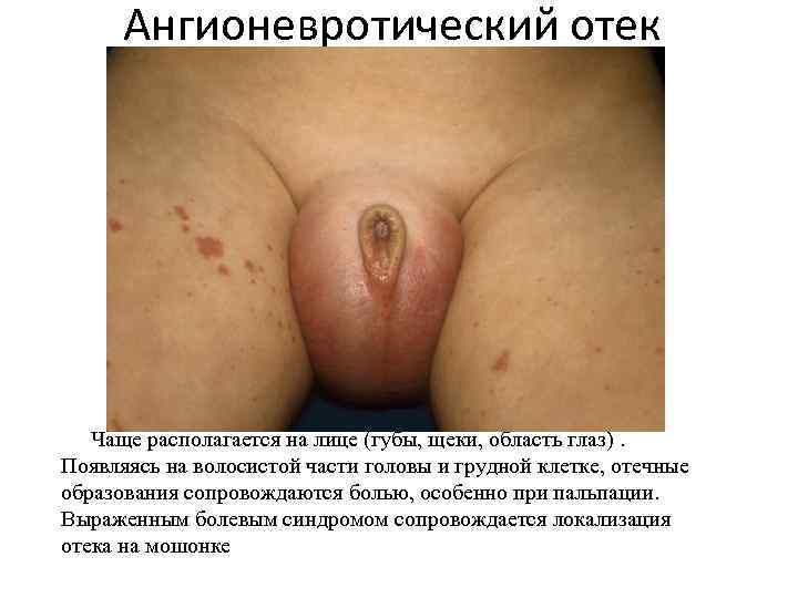 Ангионевротический отек Чаще располагается на лице (губы, щеки, область глаз). Появляясь на волосистой части