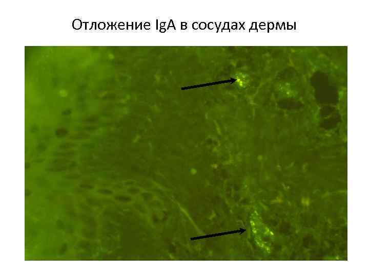 Отложение Ig. А в сосудах дермы 