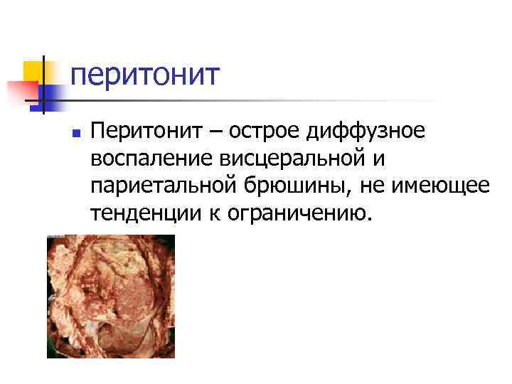 перитонит n Перитонит – острое диффузное воспаление висцеральной и париетальной брюшины, не имеющее тенденции