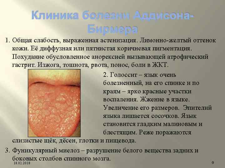 Клиника болезни Аддисона. Бирмера 1. Общая слабость, выраженная астенизация. Лимонно-желтый оттенок кожи. Её диффузная