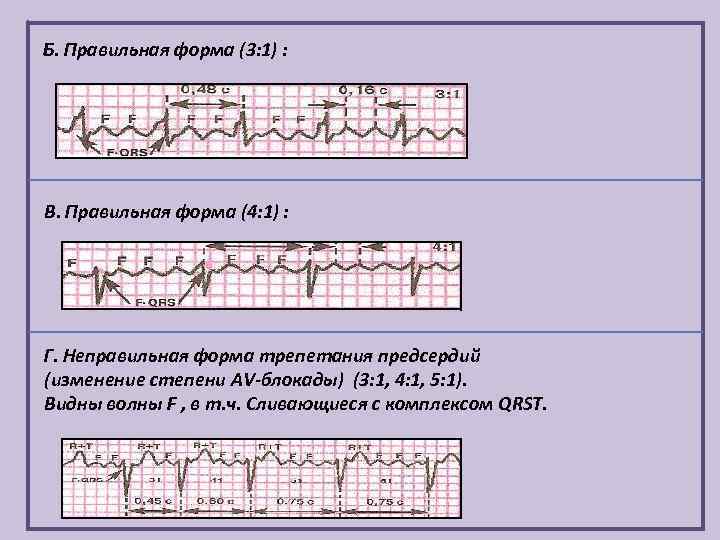 Б. Правильная форма (3: 1) : В. Правильная форма (4: 1) : Г. Неправильная