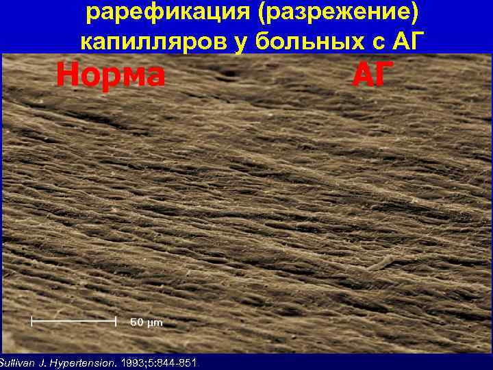 рарефикация (разрежение) капилляров у больных с АГ Норма Sullivan J. Hypertension. 1993; 5: 844