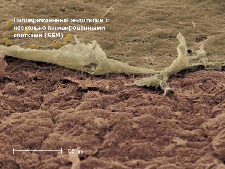Неповрежденный эндотелий с несколько активированными клетками (SEM) 