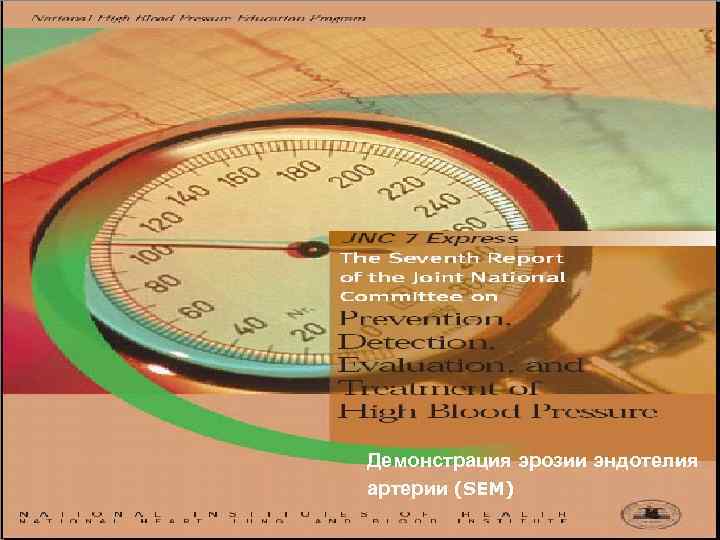 Демонстрация эрозии эндотелия артерии (SEM) 