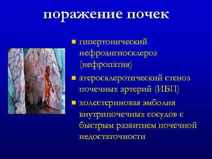 поражение почек гипертонический нефроангиосклероз (нефропатия) n атеросклеротический стеноз почечных артерий (ИБП) n холестериновая эмболия