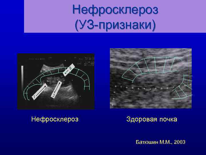 Нефросклероз (УЗ-признаки) Нефросклероз Здоровая почка Батюшин М. М. , 2003 