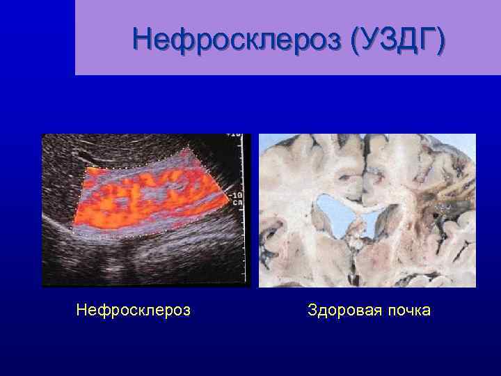 Нефросклероз (УЗДГ) Нефросклероз Здоровая почка 