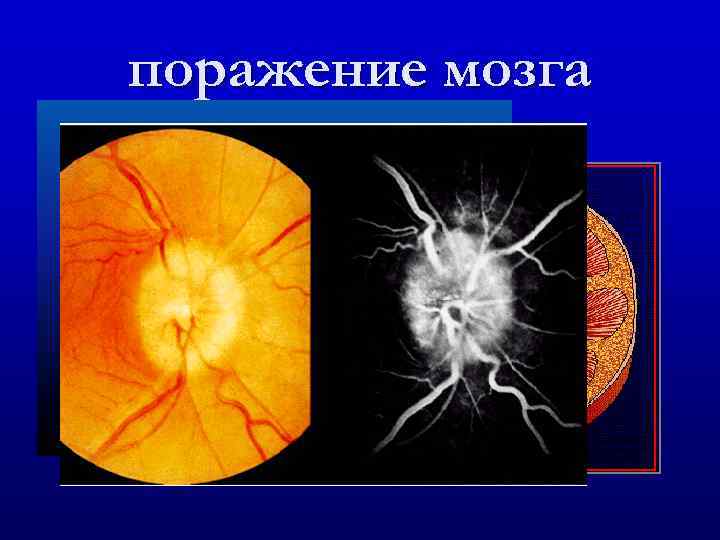 поражение мозга 