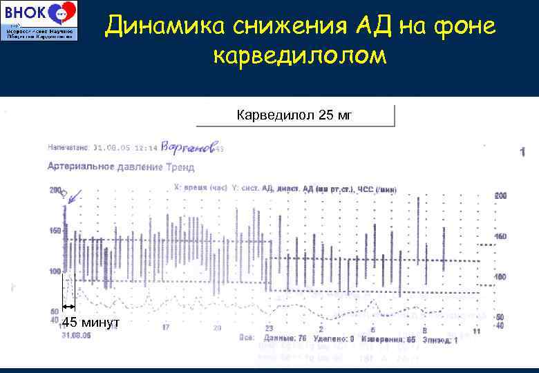 Динамика снижения АД на фоне карведилолом Карведилол 25 мг 45 минут 