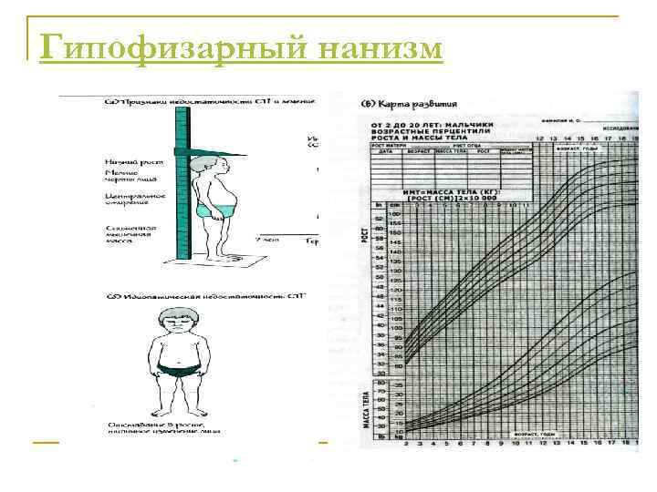 Гипофизарный нанизм 