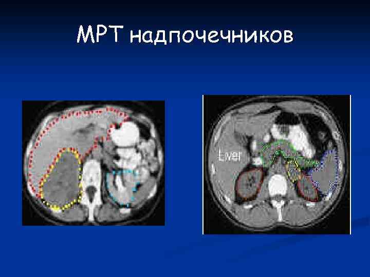 Киста надпочечника