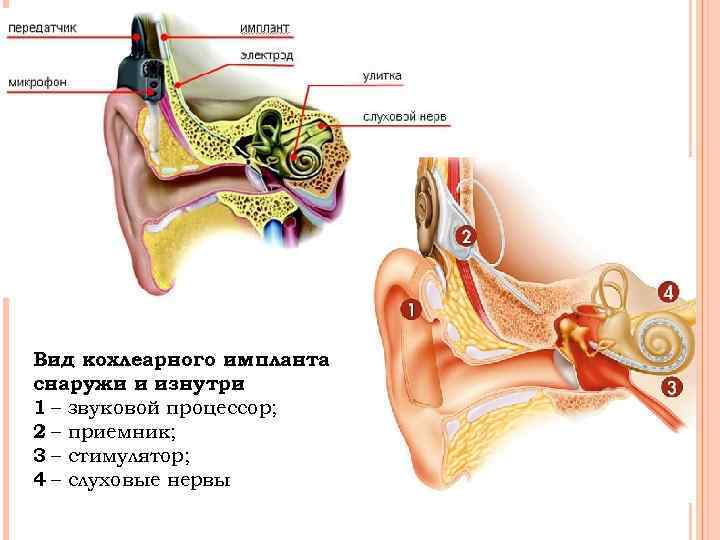 Вид кохлеарного импланта снаружи и изнутри 1 – звуковой процессор; 2 – приемник; 3