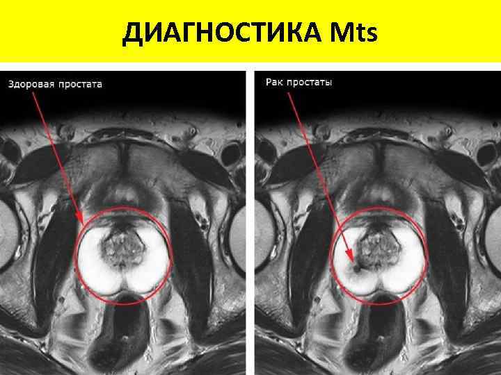 ДИАГНОСТИКА Mts Способ Чувствительн Специфичность, CI визуализации ость, % % Рентген 78 85 95%