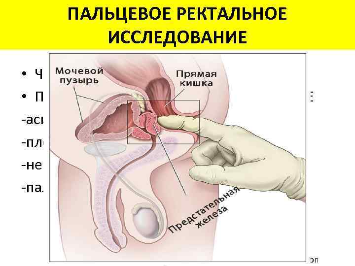 ПАЛЬЦЕВОЕ РЕКТАЛЬНОЕ ИССЛЕДОВАНИЕ • Чаще периферическая зона • При объеме >0, 2 мл обнаруживается