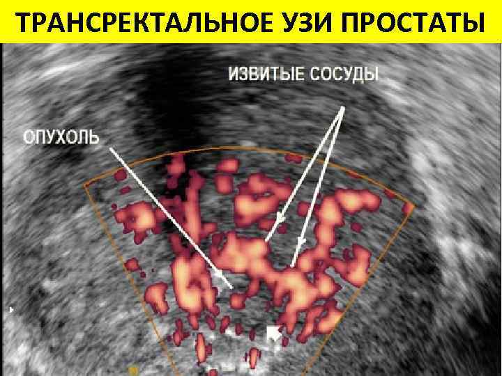 ТРАНСРЕКТАЛЬНОЕ УЗИ ПРОСТАТЫ 