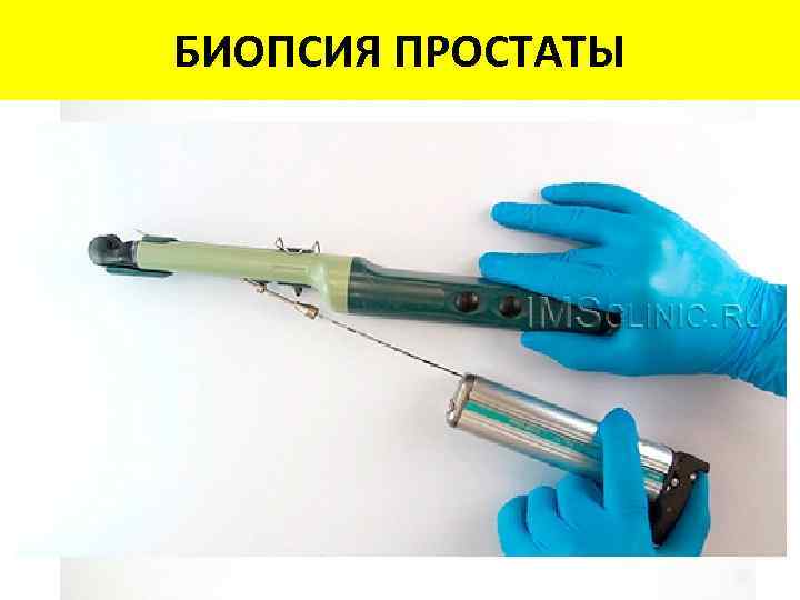 БИОПСИЯ ПРОСТАТЫ Оценка Глисона 2 -6 7(3+4) 7(4+3) Уровень ISUP 2 1 2 3