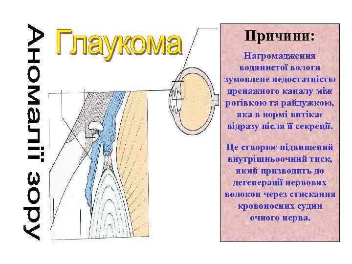 Причини: Нагромадження водянистої вологи зумовлене недостатністю дренажного каналу між рогівкою та райдужкою, яка в