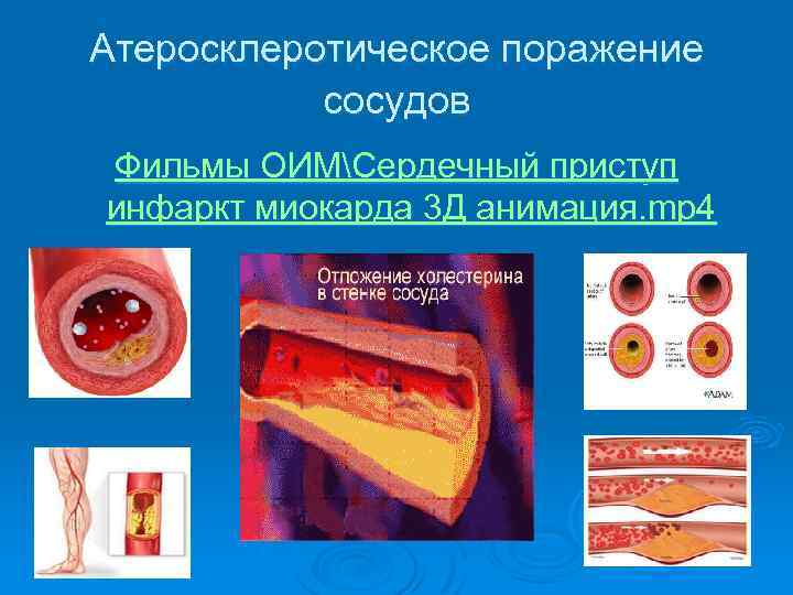 Атеросклеротическое поражение сосудов Фильмы ОИМСердечный приступ инфаркт миокарда 3 Д анимация. mp 4 