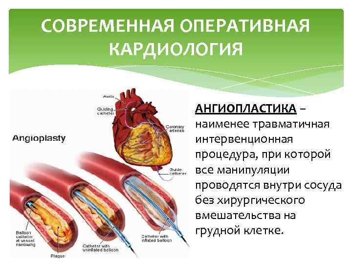 СОВРЕМЕННАЯ ОПЕРАТИВНАЯ КАРДИОЛОГИЯ АНГИОПЛАСТИКА – наименее травматичная интервенционная процедура, при которой все манипуляции проводятся