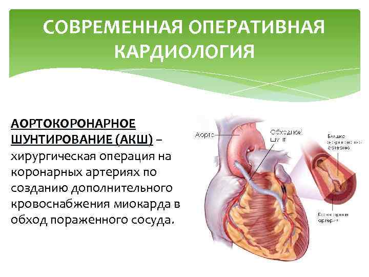 СОВРЕМЕННАЯ ОПЕРАТИВНАЯ КАРДИОЛОГИЯ АОРТОКОРОНАРНОЕ ШУНТИРОВАНИЕ (АКШ) – хирургическая операция на коронарных артериях по созданию