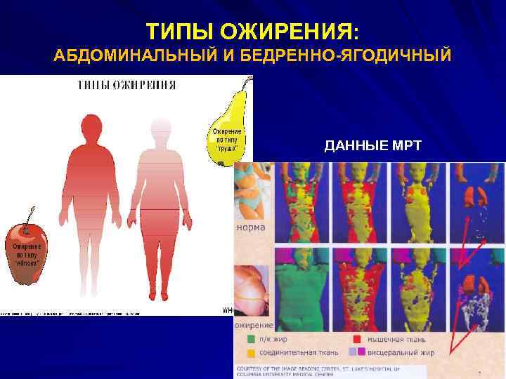 ТИПЫ ОЖИРЕНИЯ: АБДОМИНАЛЬНЫЙ И БЕДРЕННО-ЯГОДИЧНЫЙ ДАННЫЕ МРТ 