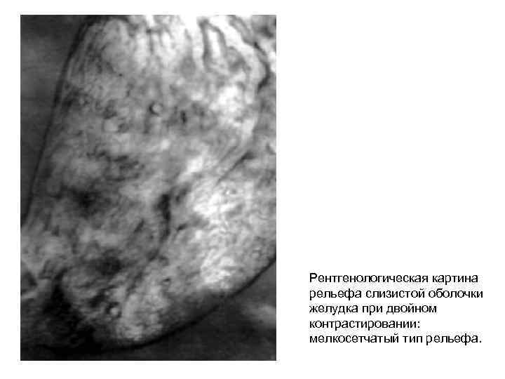 Рентгенологическая картина рельефа слизистой оболочки желудка при двойном контрастировании: мелкосетчатый тип рельефа. 