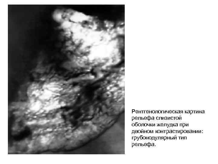 Рентгенологическая картина рельефа слизистой оболочки желудка при двойном контрастировании: грубонодулярный тип рельефа. 