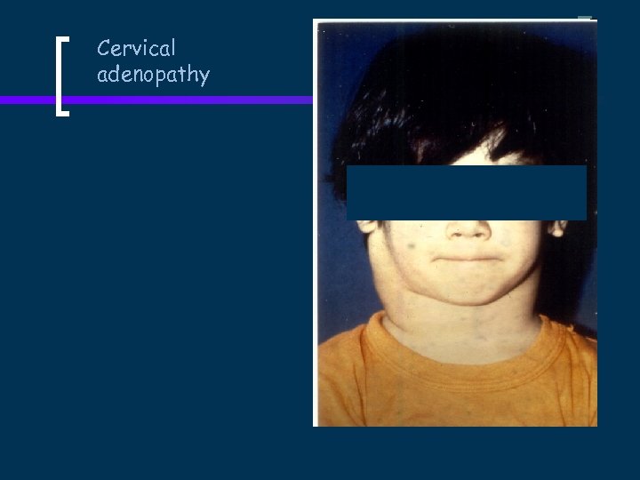 Cervical adenopathy 