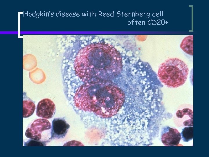 Hodgkin’s disease with Reed Sternberg cell often CD 20+ 