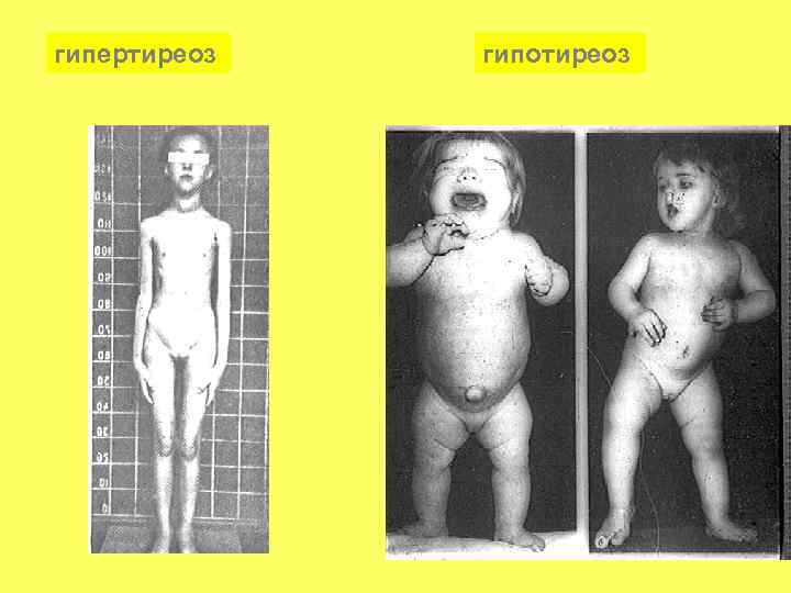 гипертиреоз гипотиреоз 