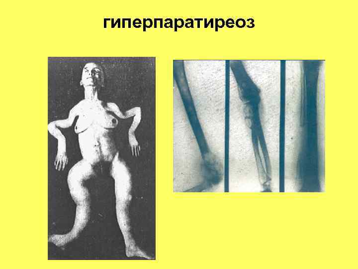 гиперпаратиреоз 