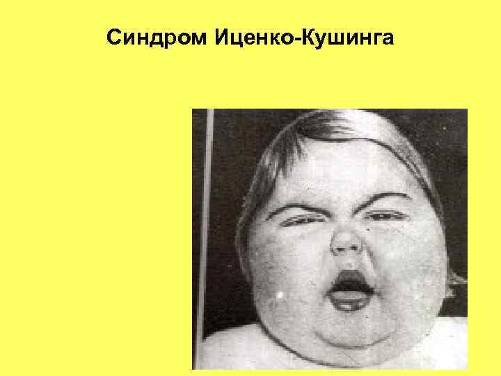 Синдром Иценко-Кушинга 