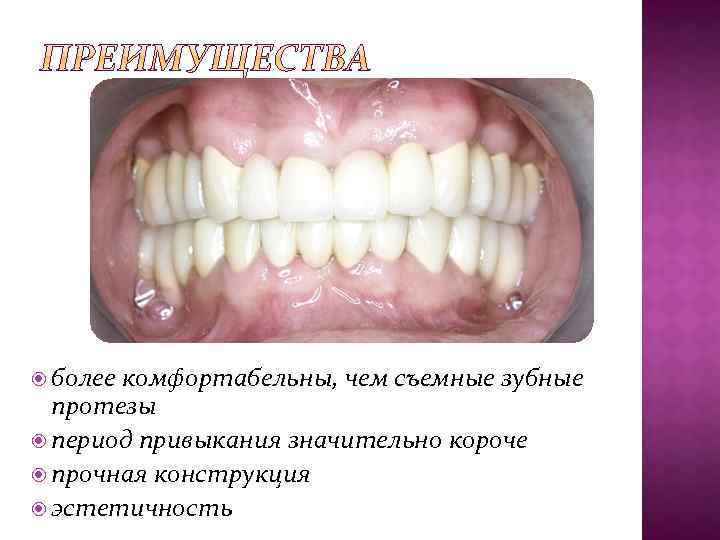  более комфортабельны, чем съемные зубные протезы период привыкания значительно короче прочная конструкция эстетичность