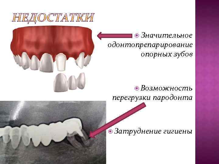  Значительное одонтопрепарирование опорных зубов Возможность перегрузки пародонта Затруднение гигиены 