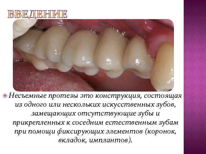  Несъемные протезы это конструкция, состоящая из одного или нескольких искусственных зубов, замещающих отсутствующие