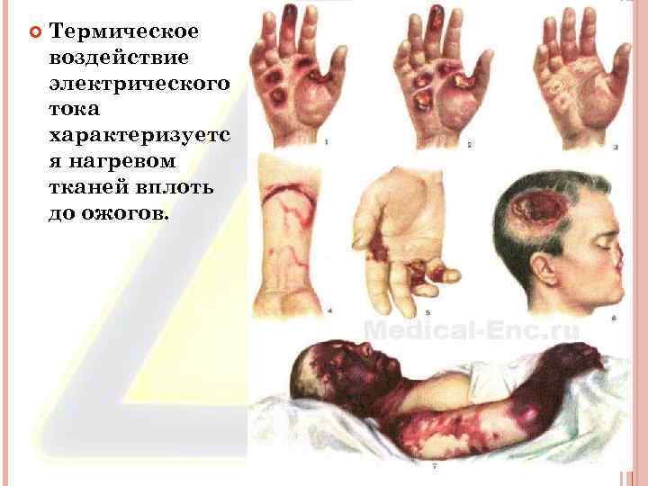  Термическое воздействие электрического тока характеризуетс я нагревом тканей вплоть до ожогов. 