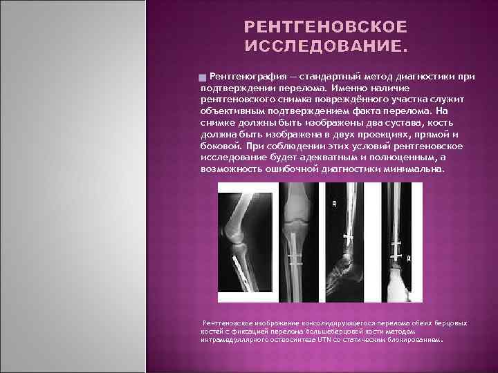 РЕНТГЕНОВСКОЕ ИССЛЕДОВАНИЕ. Рентгенография — стандартный метод диагностики при подтверждении перелома. Именно наличие рентгеновского снимка