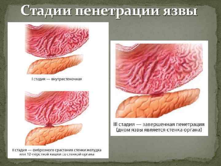 Стадии пенетрации язвы 