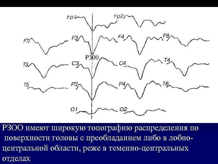 РЗОО имеют широкую топографию распределения по поверхности головы с преобладанием либо в лобноцентральной области,