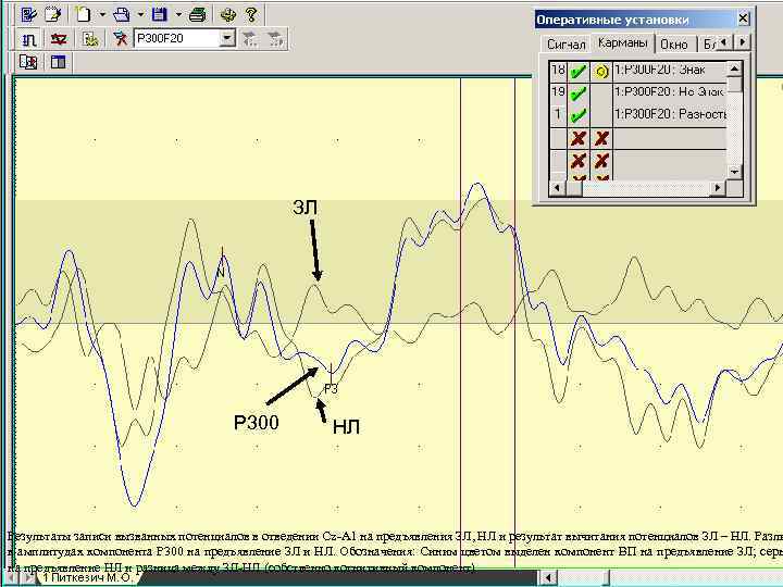 ЗЛ Р 300 НЛ Результаты записи вызванных потенциалов в отведении Сz-A 1 на предъявления