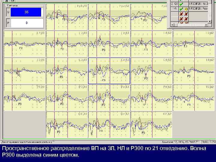 Пространственное распределение ВП на ЗЛ, НЛ и Р 300 по 21 отведению. Волна Р