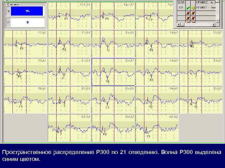 Пространственное распределение Р 300 по 21 отведению. Волна Р 300 выделена синим цветом. 