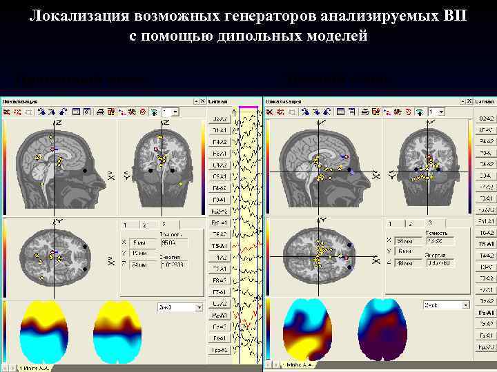 Локализация возможных генераторов анализируемых ВП с помощью дипольных моделей Правдивый ответ Ложный ответ 