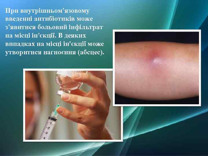 При внутрішньом'язовому введенні антибіотиків може з'явитися больовий інфільтрат на місці ін'єкції. В деяких випадках