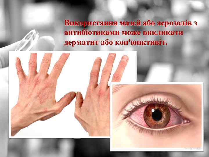 Використання мазей або аерозолів з антибіотиками може викликати дерматит або кон'юнктивіт. 