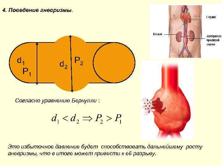 4. Поведение аневризмы. d 1 P 1 d 2 P 2 Согласно уравнению Бернулли